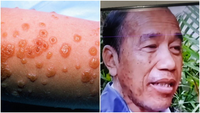 Jokowi Dikabarkan Derita Sindrom SJS: Bisa Disebabkan oleh Obat Antikejang, Ini Gejala dan Bahayanya
