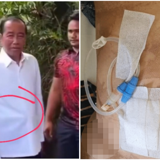 Tak Hanya Wajah, Perut Jokowi Juga Disorot Saat Acara Ulang Tahun, Dokter Tifa Duga Itu Alat CAPD