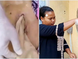 Kasa Tertinggal di Perut Lansia Usai Operasi, RS Bilang Semua Sudah Sesuai Prosedur