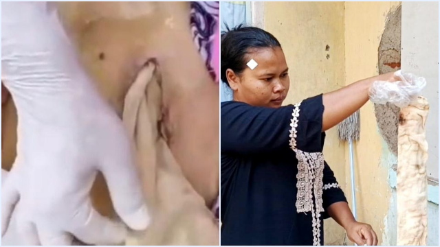 Kasa Tertinggal di Perut Lansia Usai Operasi, RS Bilang Semua Sudah Sesuai Prosedur