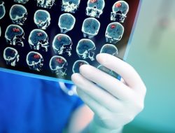 7 Tanda Tumor Otak yang Disangka Masalah Sepele: No. 3 Sering Diabaikan!