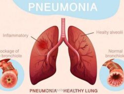 Hari Pneumonia Sedunia 2025: Fokus pada Kelangsungan Hidup Anak dari Ancaman Mematikan