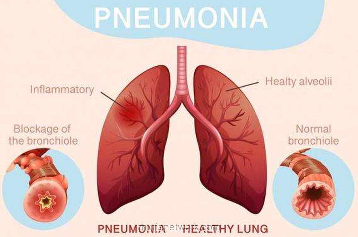 Hari Pneumonia Sedunia 2025: Fokus pada Kelangsungan Hidup Anak dari Ancaman Mematikan