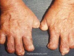 Kembalinya Kusta di Rumania, Salon Mewah Cluj-Napoca Ditutup Darurat