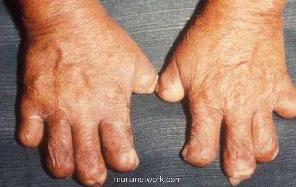 Kembalinya Kusta di Rumania, Salon Mewah Cluj-Napoca Ditutup Darurat