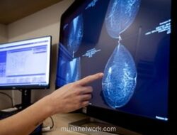 AI Baca Mammogram, Deteksi Kanker Payudara Meski Hasilnya Bersih