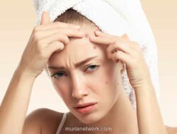 Jerawat di Dahi Mengganggu? Ini Solusi Alami hingga Medis yang Bisa Dicoba