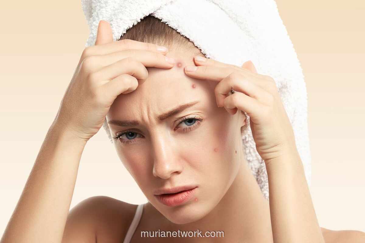 Jerawat di Dahi Mengganggu? Ini Solusi Alami hingga Medis yang Bisa Dicoba