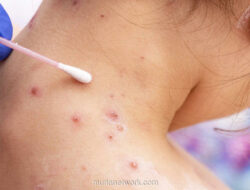 Bayi 42 Hari Tertular Cacar Air Usai Dijenguk Tamu