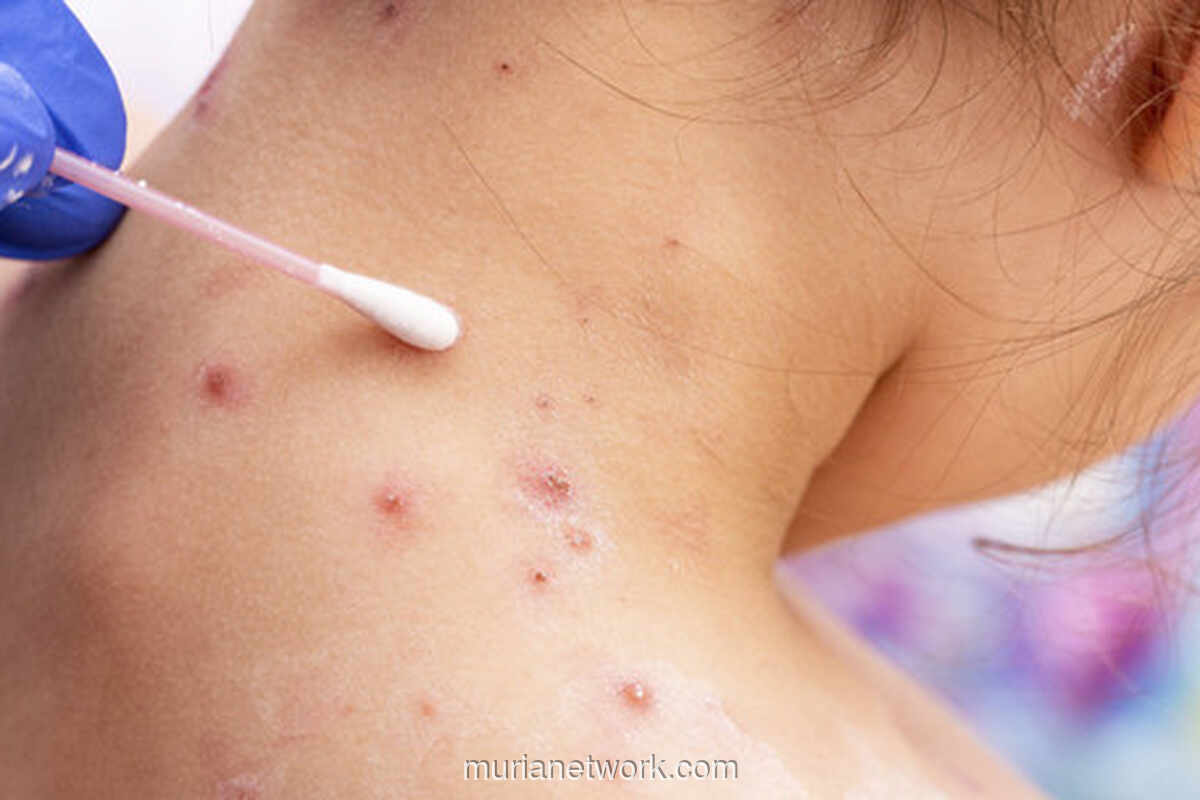 Bayi 42 Hari Tertular Cacar Air Usai Dijenguk Tamu