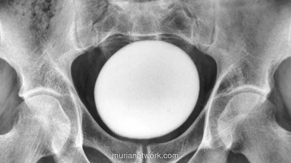 Batu Seberat 826 Gram Dikeluarkan dari Kandung Kemih Pria Iran