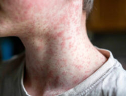 South Carolina Pecahkan Rekor Kasus Campak Terburuk dalam Tiga Dekade