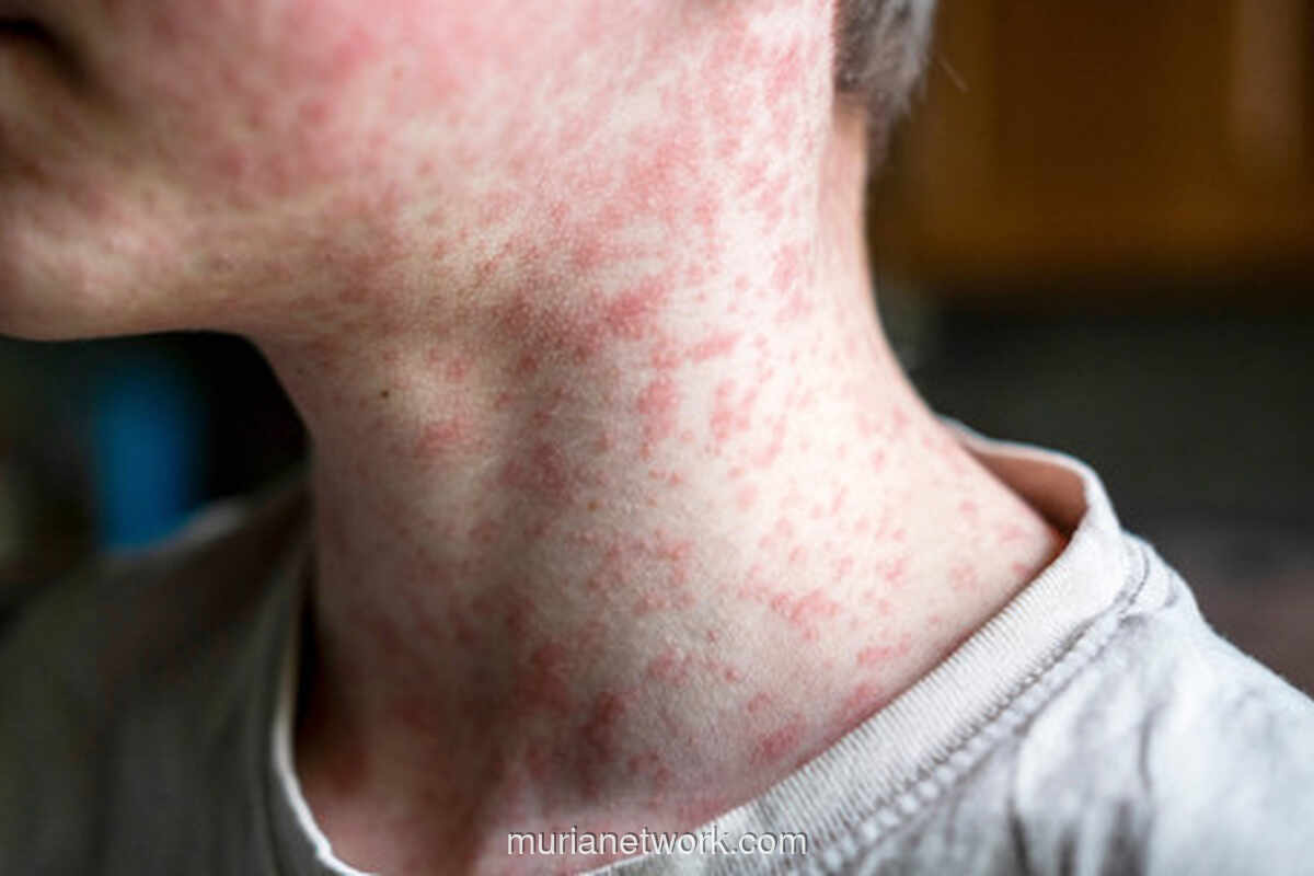 South Carolina Pecahkan Rekor Kasus Campak Terburuk dalam Tiga Dekade