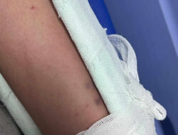 Kobra Numpang Paket Karpet, Remaja Sukoharjo Terkapar di ICU