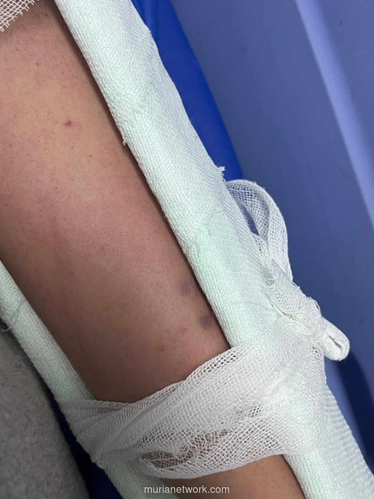 Kobra Numpang Paket Karpet, Remaja Sukoharjo Terkapar di ICU