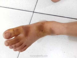 Gadis 9 Tahun Terseret Motor Saat Berjuang Pertahankan Ponsel dari Pencuri