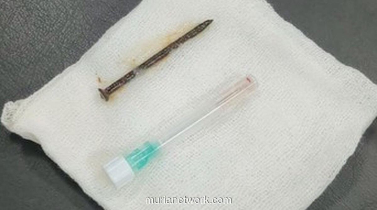 Pria di Riau Tersedak Paku 5 cm, Berhasil Dikeluarkan dari Paru-Paru