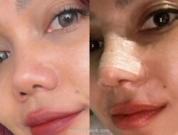 Rina Nose Jalani Operasi Hidung oleh Dokter Tompi di Awal Ramadhan 2026