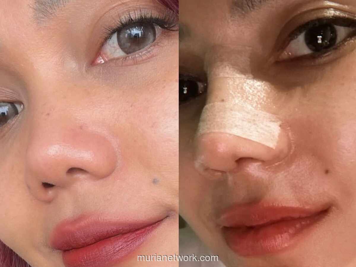 Rina Nose Jalani Operasi Hidung oleh Dokter Tompi di Awal Ramadhan 2026
