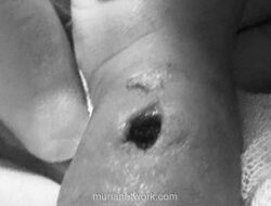 Orang Tua Somasi RSIA Makassar Diduga Lakukan Kelalaian hingga Tangan Bayi 9 Bulan Berlubang