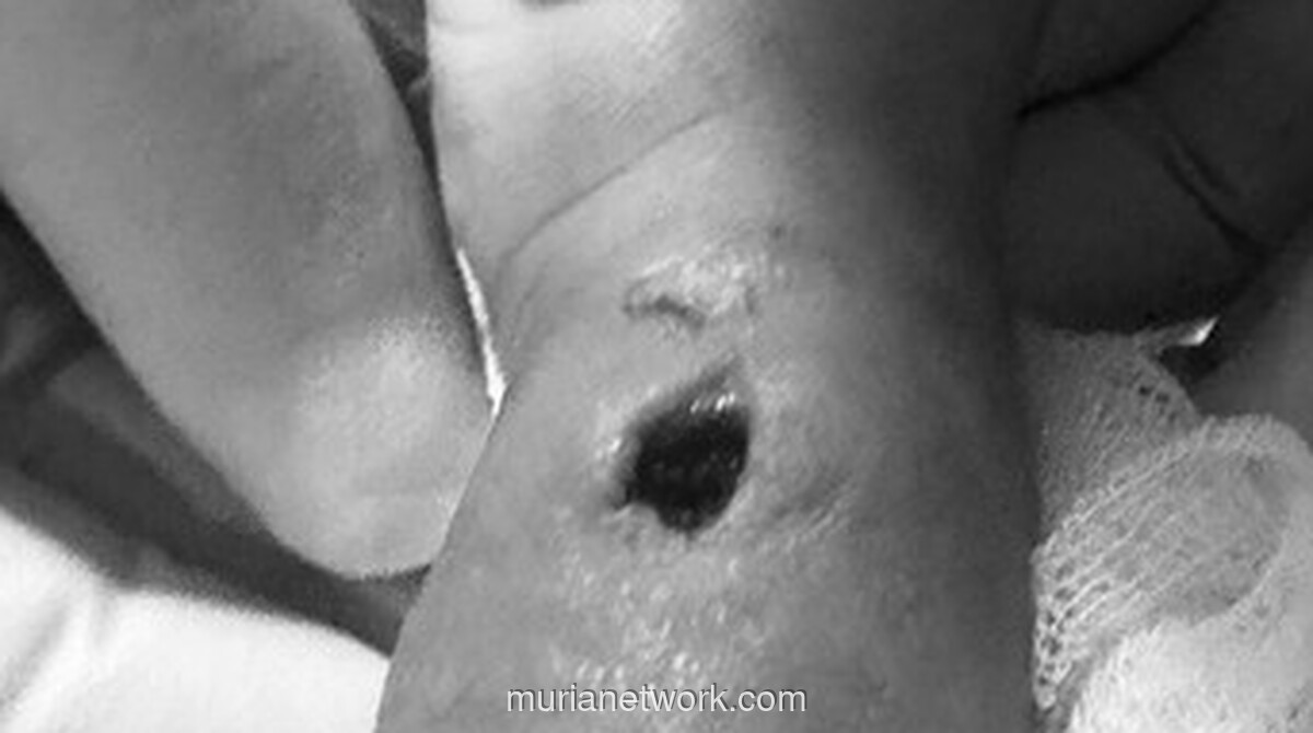 Orang Tua Somasi RSIA Makassar Diduga Lakukan Kelalaian hingga Tangan Bayi 9 Bulan Berlubang