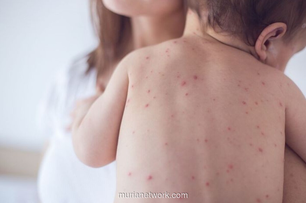 Kemenkes Waspadai 8.224 Kasus Suspek Campak hingga Pekan Ketujuh 2026