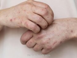 DPRD Banten Panggil Dinkes, Waspadai Lonjakan 2.000 Suspek Campak