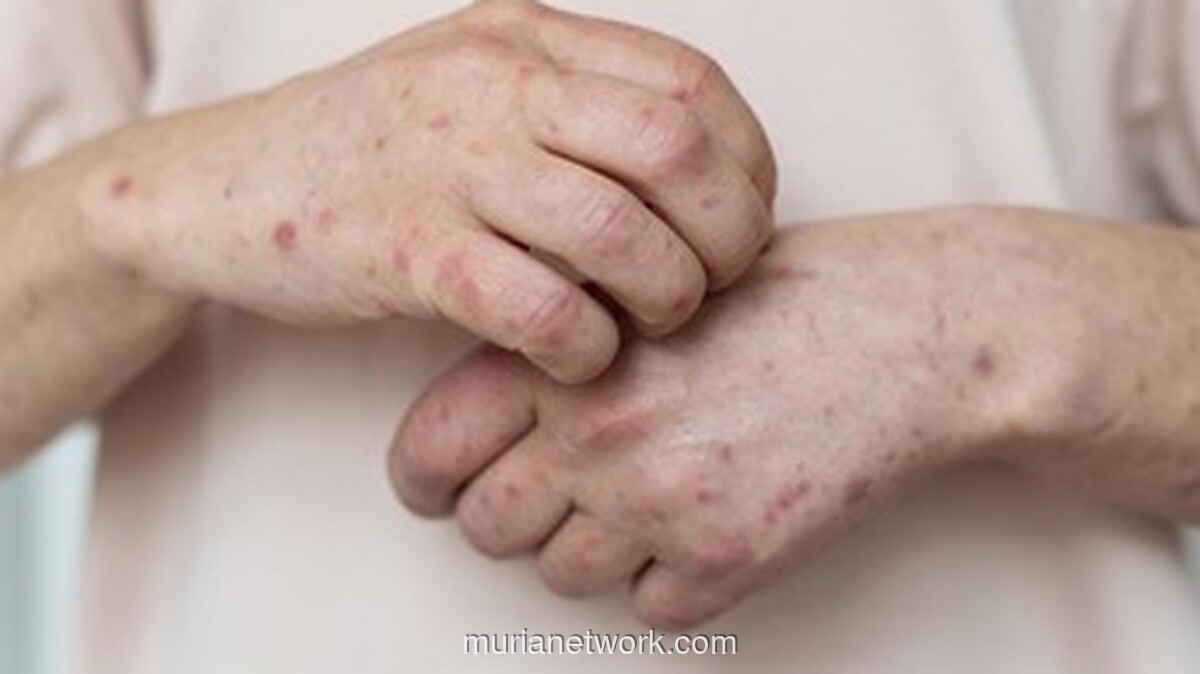 DPRD Banten Panggil Dinkes, Waspadai Lonjakan 2.000 Suspek Campak