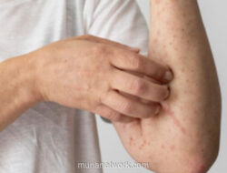 Dinkes Sultra Waspadai Potensi Penularan Campak Pasca-Mudik Lebaran