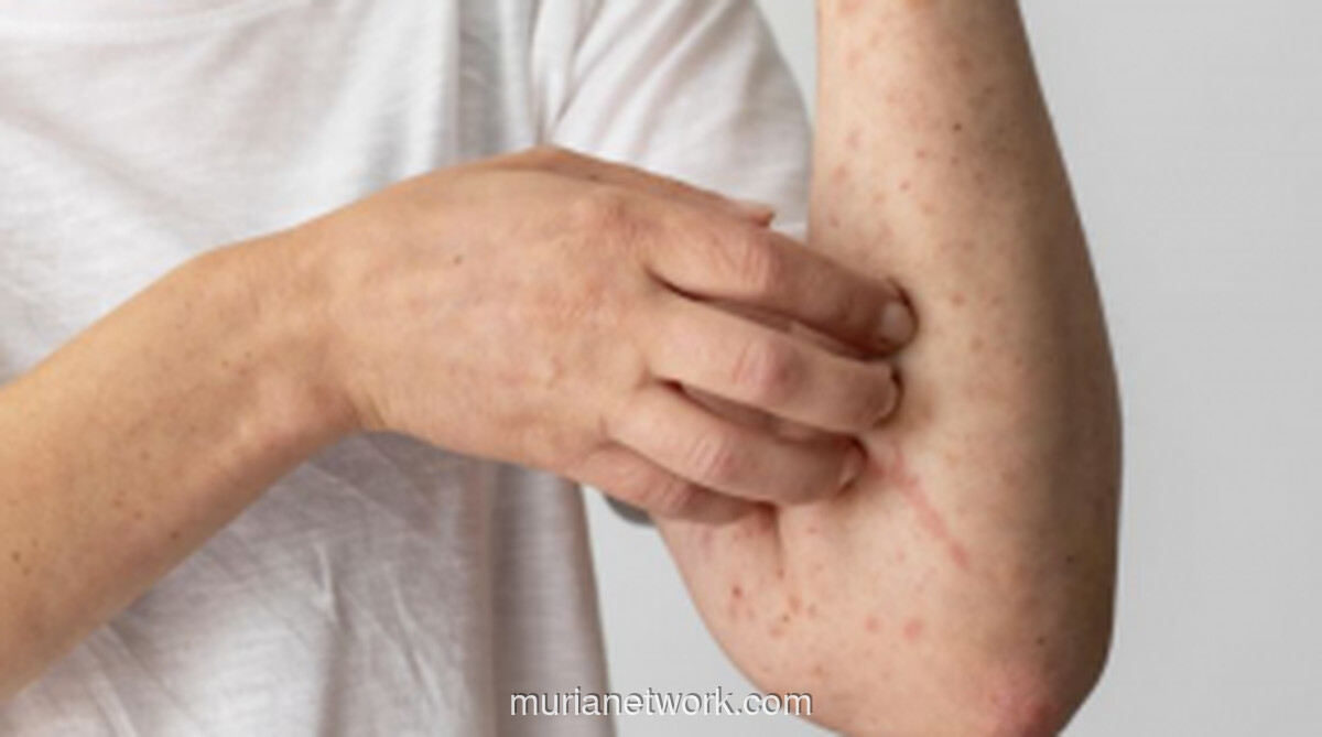 Dinkes Sultra Waspadai Potensi Penularan Campak Pasca-Mudik Lebaran