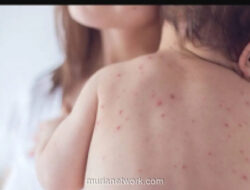 Dinkes DKI Ingatkan Waspada Penularan Campak Saat Silaturahmi Lebaran