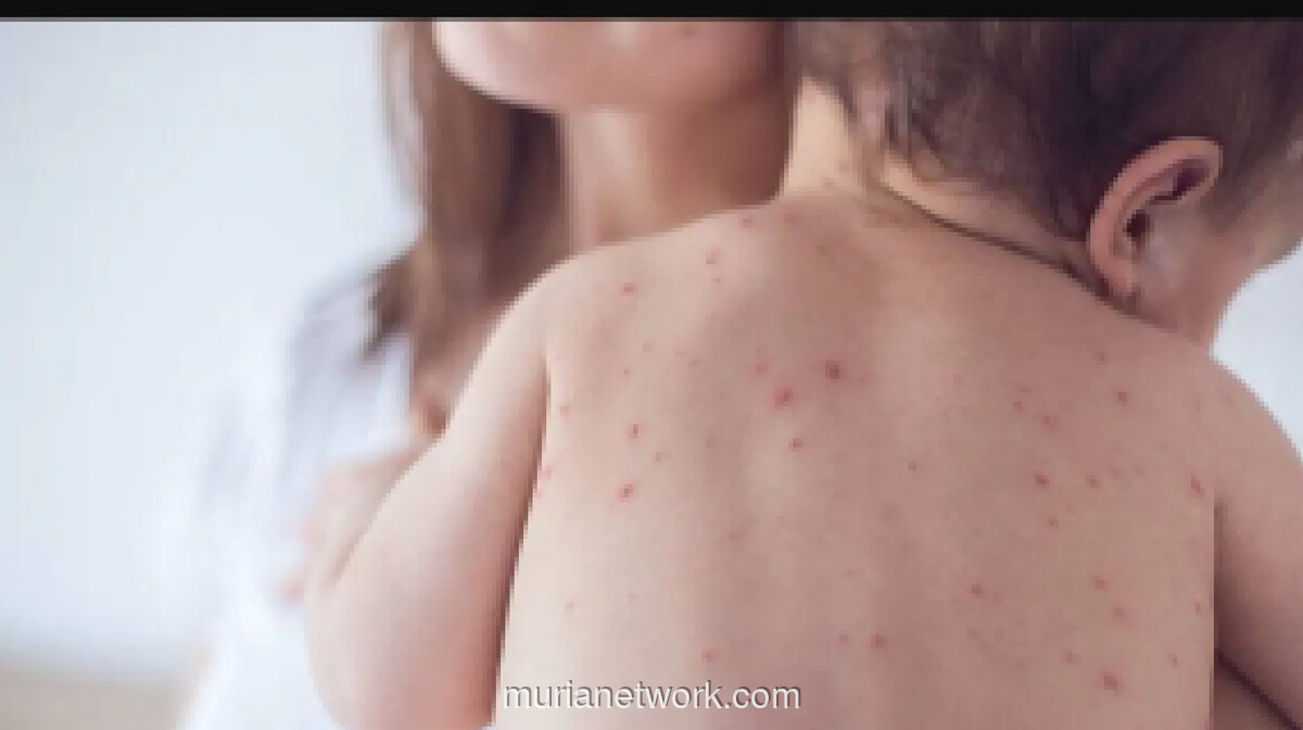 Dinkes DKI Ingatkan Waspada Penularan Campak Saat Silaturahmi Lebaran