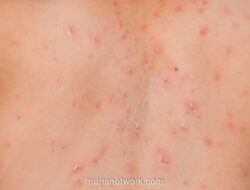 DKI Jakarta Gelar Imunisasi Kejar Serentak Campak di Maret 2026