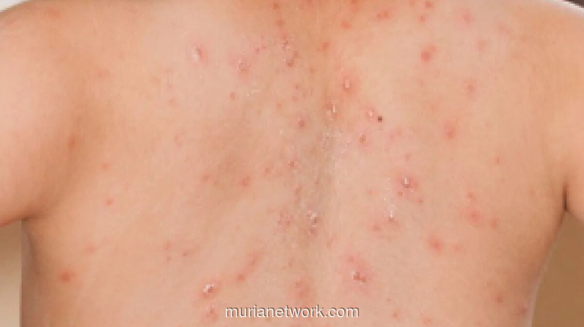 DKI Jakarta Gelar Imunisasi Kejar Serentak Campak di Maret 2026