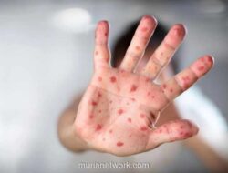 Maros Gelar Pelatihan Respons Cegah KLB Campak Usai 31 Anak Terkonfirmasi Positif