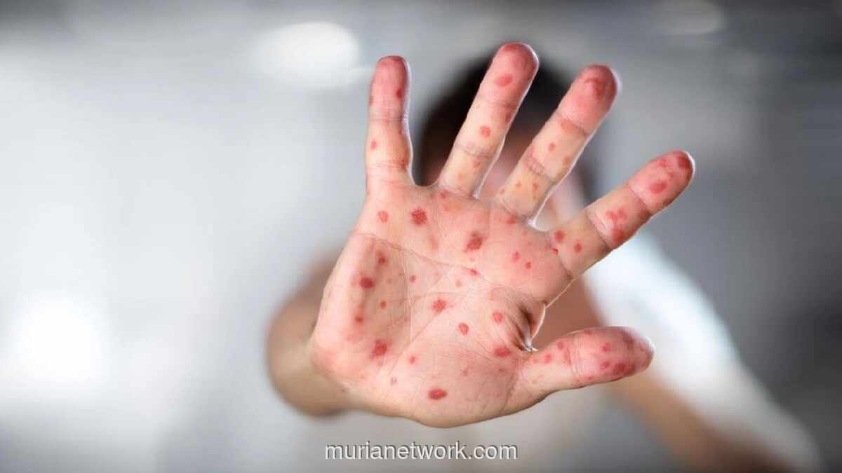 Maros Gelar Pelatihan Respons Cegah KLB Campak Usai 31 Anak Terkonfirmasi Positif