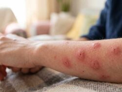 Waspada Syok Anafilaktik, Reaksi Alergi Berat yang Bisa Berakibat Fatal