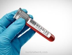 Dinkes Banten Waspadai Lonjakan Kasus Campak Usai 6 Pasien Meninggal