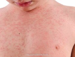 Kasus Campak Turun Drastis 93%, Kemenkes Percepat Vaksinasi untuk Tenaga Medis