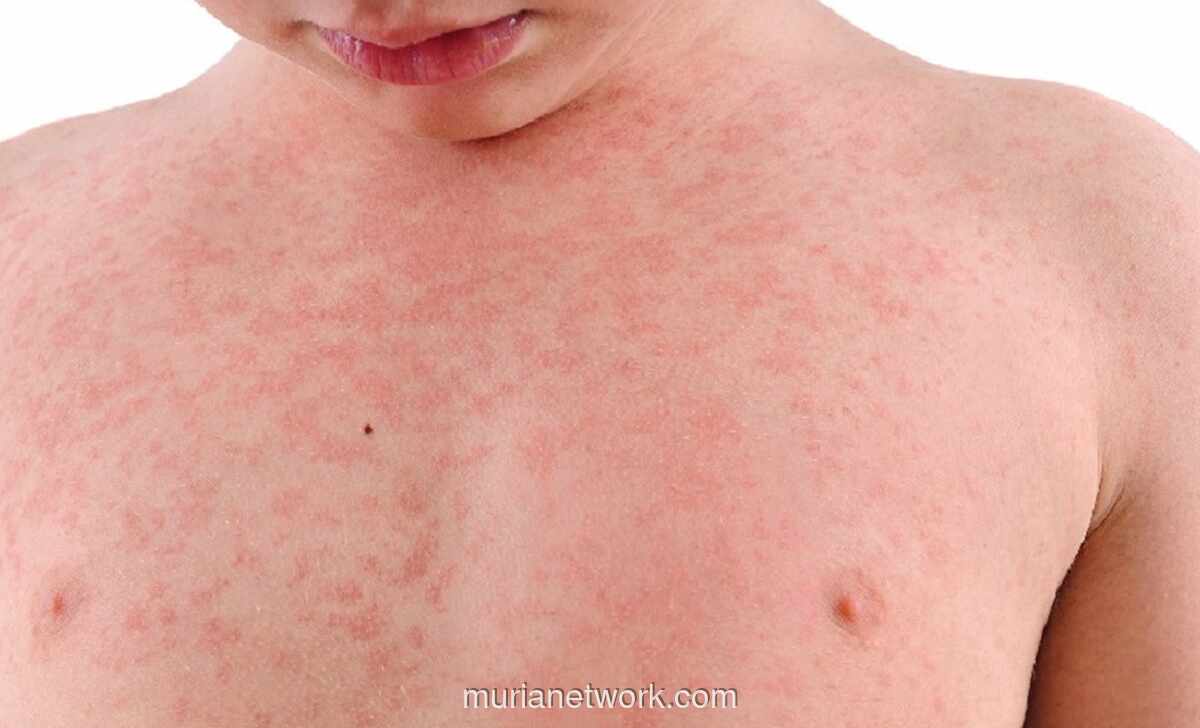 Kasus Campak Turun Drastis 93%, Kemenkes Percepat Vaksinasi untuk Tenaga Medis