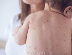 Kasus Campak Anjlok 93%, Kemenkes Wajibkan Vaksinasi untuk Dokter Internsip