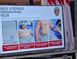 Kondisi Andrie Yunus Membaik, Cangkok Kulit Berjalan, Mata Masih Dipantau Ketat