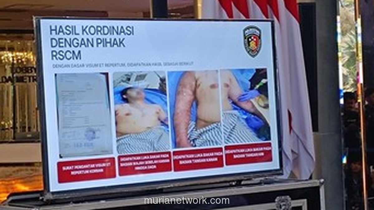 Kondisi Andrie Yunus Membaik, Cangkok Kulit Berjalan, Mata Masih Dipantau Ketat