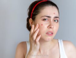 Dokter Kulit Ungkap Langkah Awal Atasi Iritasi Akibat Skincare Ilegal