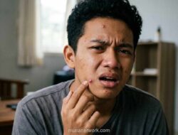 Dokter Ungkap Jerawat Tak Hanya karena Wajah Kotor, Kesehatan Usus Juga Jadi Pemicu