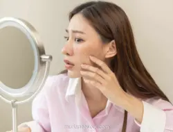 Bukan Sekadar Flek, Melasma Butuh Penanganan Khusus