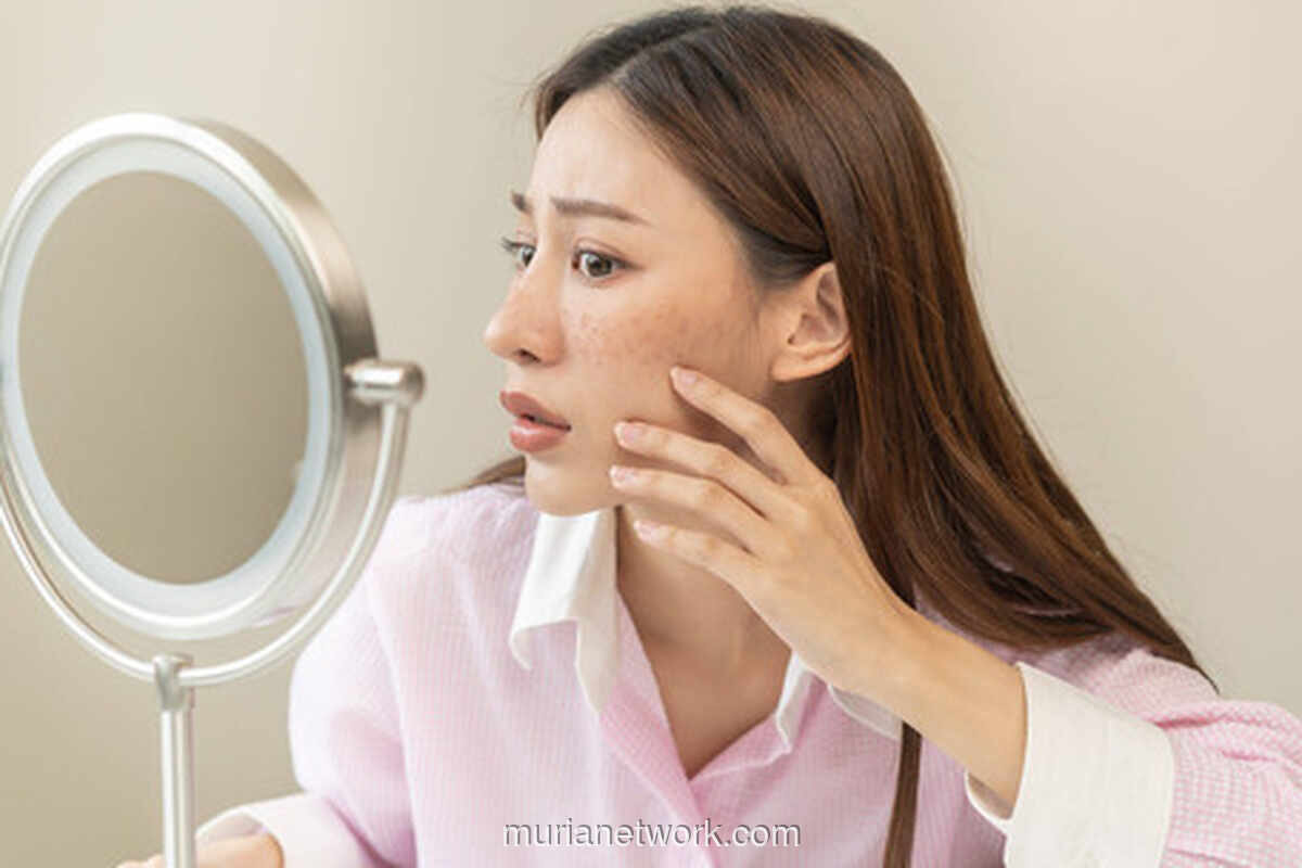 Bukan Sekadar Flek, Melasma Butuh Penanganan Khusus